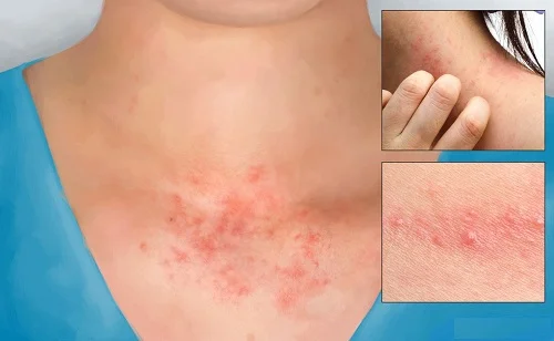 Dấu hiệu dị ứng bạc