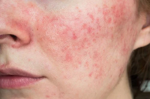 Dị ứng toner là gì