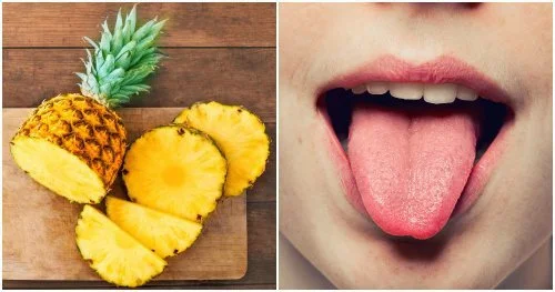 Dị ứng dứa: Dấu hiệu nhận biết và hướng xử trí theo mức độ