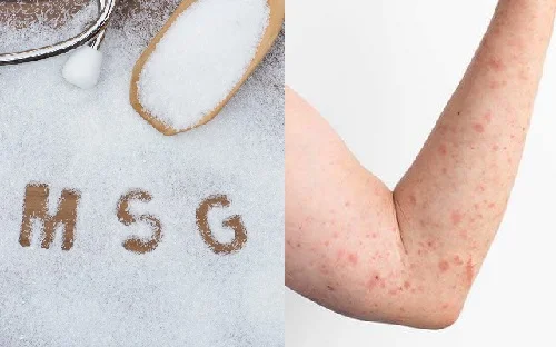 Dị ứng bột ngọt (mì chính) biểu hiện thế nào? Xử trí đơn giản