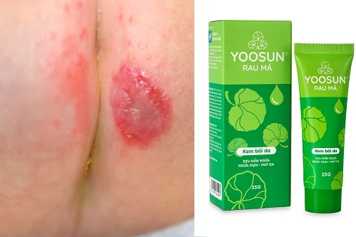 Kem Yoosun Rau má có trị hăm không? Đừng lầm tưởng