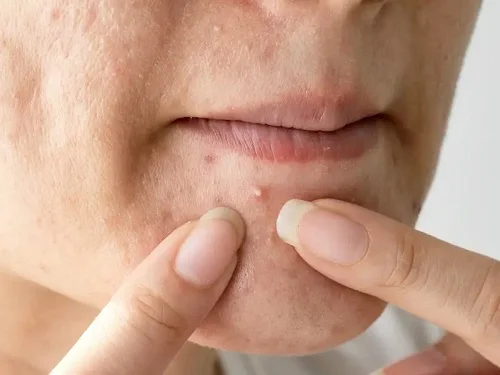 Nguyên nhân da bị dị ứng nước hoa hồng