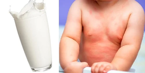 Dị ứng sữa tươi: Dấu hiệu dễ bị nhầm lẫn và hướng xử lý
