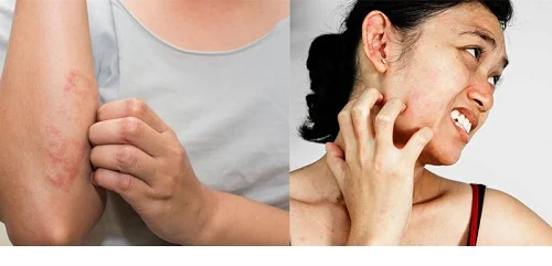 bị dị ứng có nên tắm không