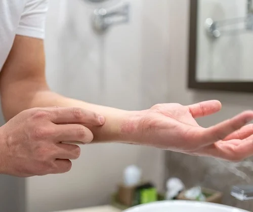 Bị dị ứng có tự khỏi được không