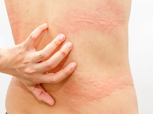 bị dị ứng có tự khỏi được không