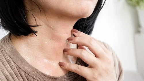 Dị ứng mồ hôi: Biểu hiện thường bị nhầm lẫn và cách xử lý