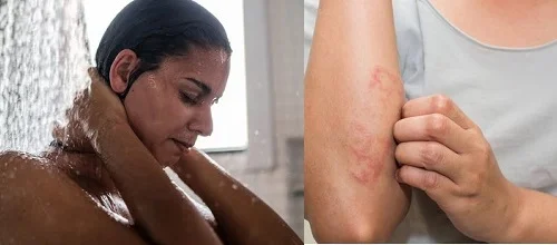 Bị dị ứng có nên tắm không? Xem ngay câu trả lời