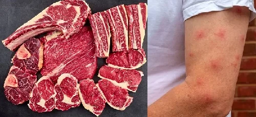 Dị ứng thịt bò bao lâu thì hết? Thời gian hồi phục và xử trí