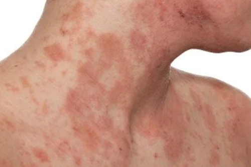 Bị dị ứng vàng có nguy hiểm không