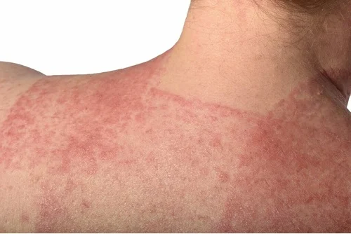 Bị dị ứng với kem chống nắng là như thế nào
