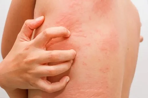 Biểu hiện dị ứng côn trùng cắn 