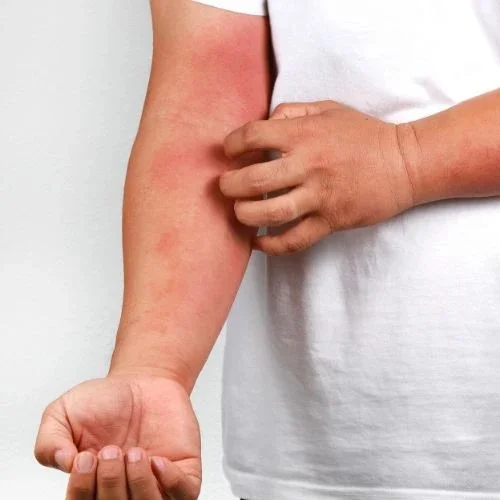 Da bị dị ứng cá hồi là như thế nào