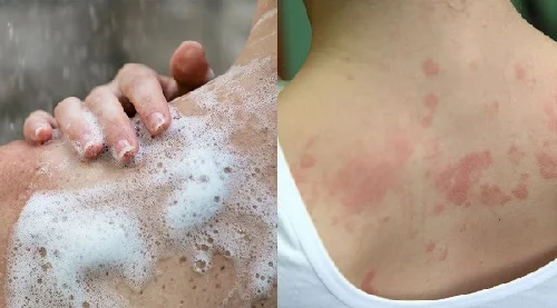 Dị ứng sữa tắm: Nhận biết và xử trí để không bị tái lại