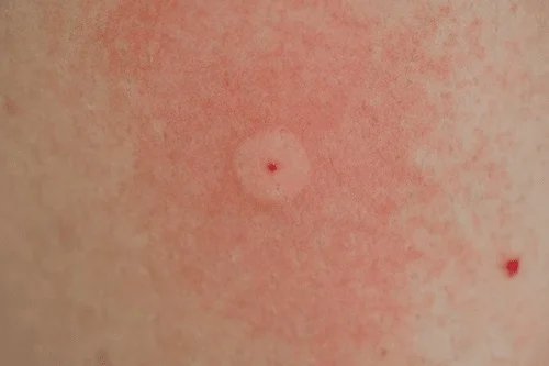 Da bị dị ứng với côn trùng đốt
