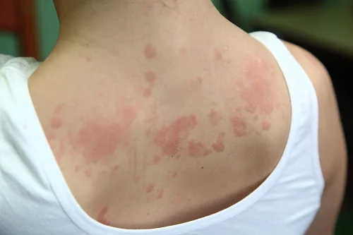 Da bị dị ứng với sữa tắm là như thế nào