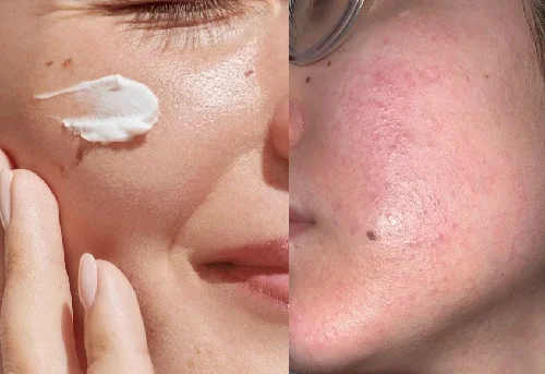 Dị ứng kem chống nắng là gì? Biểu hiện và cách xử lý để tránh bị sẹo