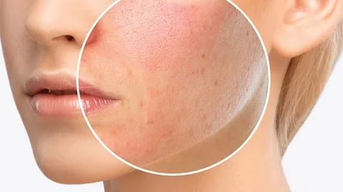 Da mặt dị ứng kem trộn là như thế nào