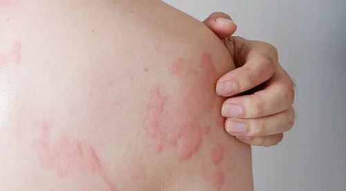 Dấu hiệu dị ứng cá hồi
