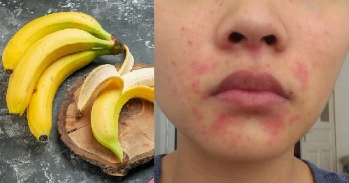 Dị ứng chuối là gì? Giải mã từ A-Z về tình trạng này