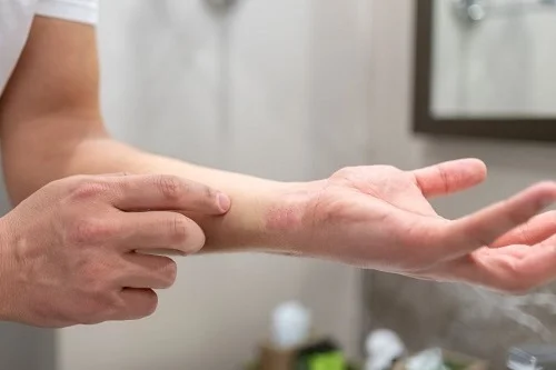 Dị ứng có tự khỏi được không? Bao lâu thì khỏi? Giải đáp