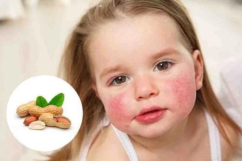Dị ứng lạc đậu phông