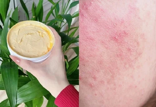 Dị ứng kem trộn: Nhận biết sớm và xử lý đúng cách để cứu làn da