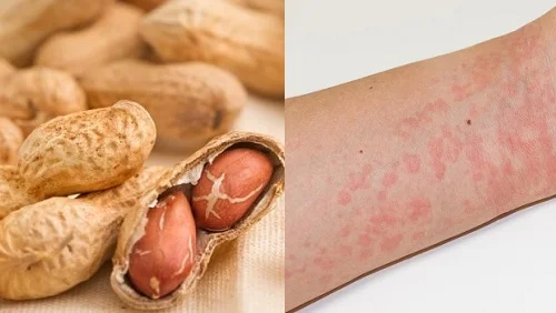 Dị ứng đậu phộng (lạc): Dấu hiệu nguy hiểm và cách xử lý