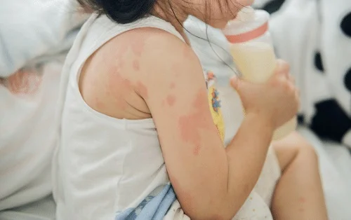 trẻ bị dị ứng bao lâu thì khỏi