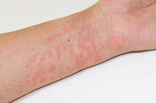 Triệu chứng dị ứng lạc