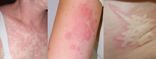 Triệu chứng dị ứng sữa tắm là gì