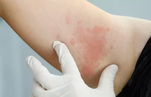 Bị dị ứng có ra gió được không