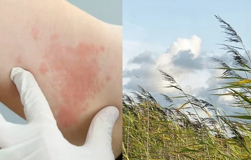 Bị dị ứng có kiêng gió không? Khi nào nên, khi nào không?