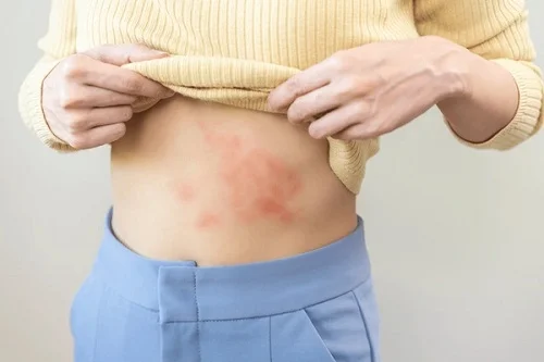 Bị dị ứng tằm là như thế nào 