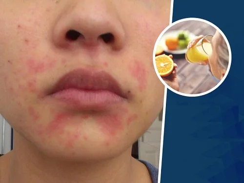Bị dị ứng có uống nước chanh được không? Câu trả lời đúng