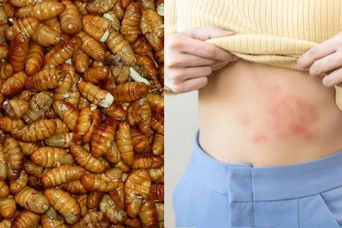 Dị ứng nhộng tằm: Mẹo nhận biết và các bước xử lý an toàn
