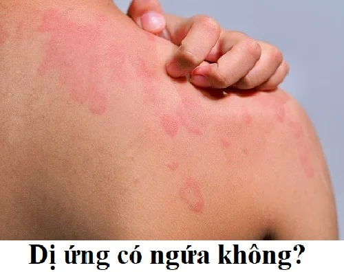 Bị dị ứng có ngứa không? Có phải lúc nào cũng gây ngứa?