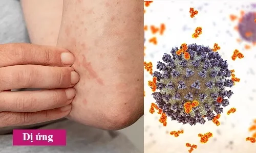 Bị dị ứng có lây không? Lý giải từ góc nhìn y khoa
