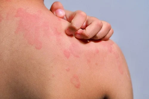 dị ứng có ngứa không