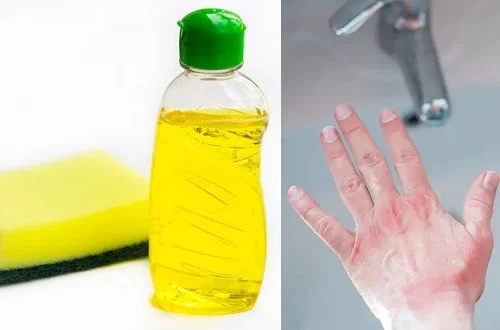 Tay bị dị ứng nước rửa chén (bát): Cách nhận biết và xử lý