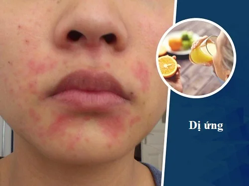 dị ứng uống nước chanh được không