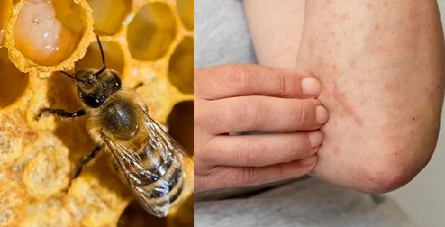 Dị ứng sữa ong chúa: Nhận biết và xử lý nhanh tránh hậu quả