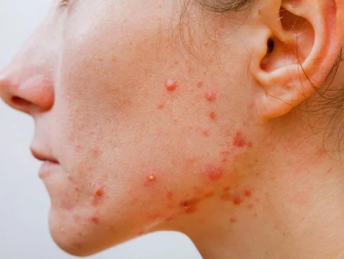 Bị dị ứng ăn thịt gà được không