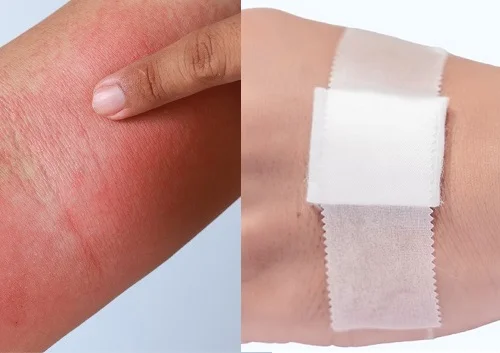 Dấu hiệu dị ứng băng dính y tế và cách xử lý, phòng tránh