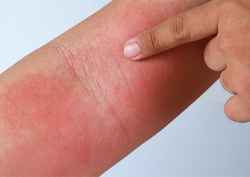 Bị dị ứng với băng dính y tế