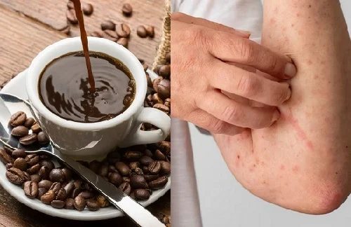 Dị ứng cafe là gì? Có giống với say cafe không? Biểu hiện và xử lý