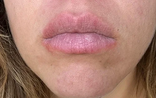 Biểu hiện dị ứng kem đánh răng