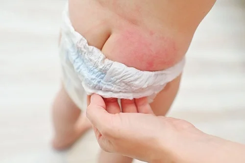 Dị ứng bỉm ở trẻ em: Dấu hiệu đặc trưng và cách xử lý hiệu quả
