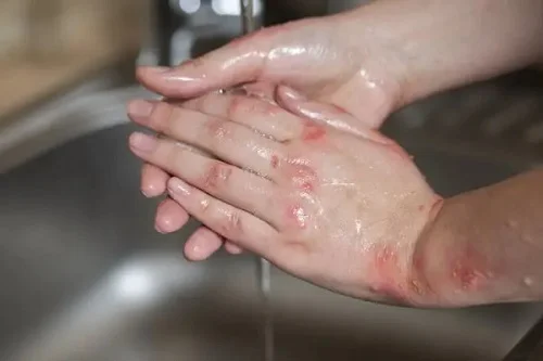 Da dị ứng nước máy nổi mụn nên làm thế nào Dị ứng nước máy nổi mụn