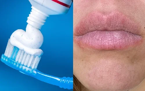 Biểu hiện dị ứng kem đánh răng và cách xử lý nhanh
